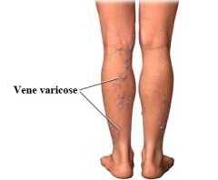come si presentano le vene varicose